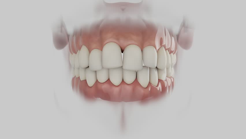3D Dental Animation — Crowded Teeth Correction with Clear Aligner