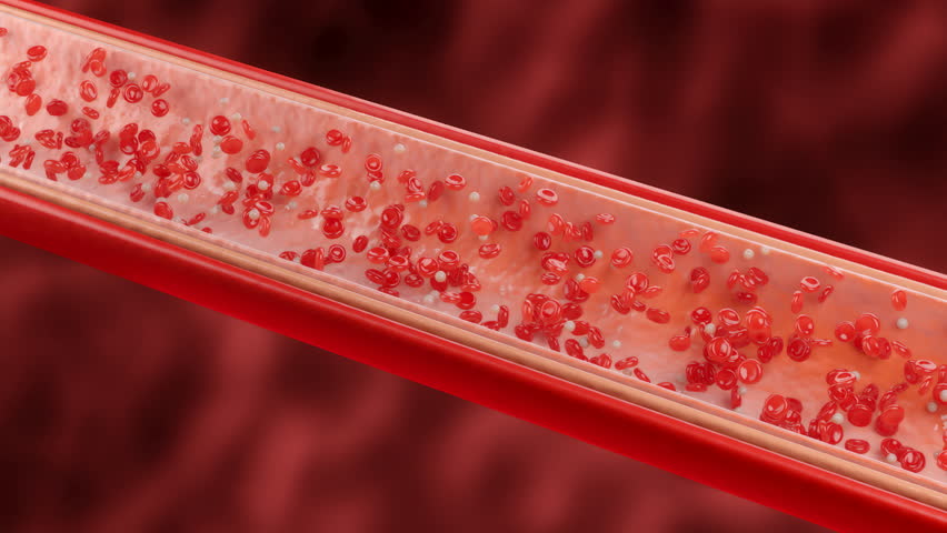 Illustration of a narrowed blood vessel with red blood cells and fatty deposits
