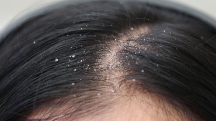 severe dandruff in women's hair
