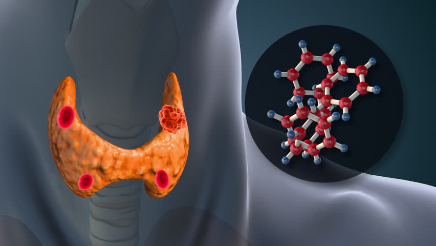 Hyperparathyroidism Disorder Affecting Human Body Hormones