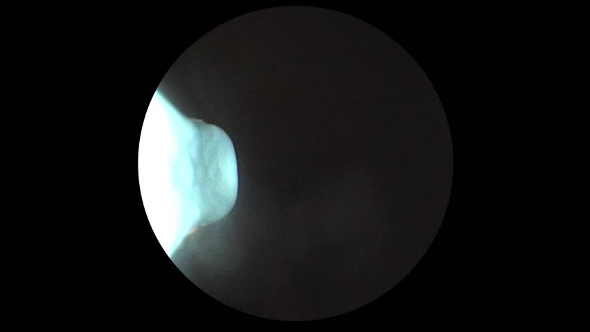 Medical endoscopic view inside a patient’s ear showing a doctor removing a chunk of earwax with a tool, illustrating healthcare, hygiene, and ear cleaning procedures. 14839  	