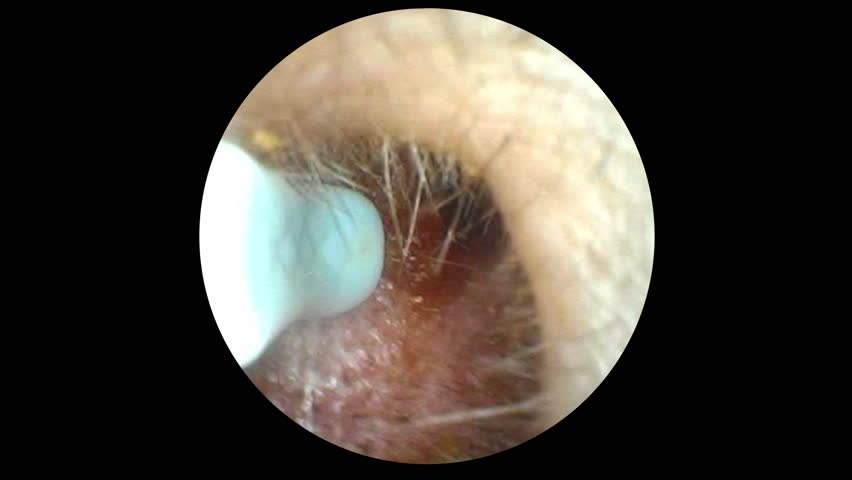 Medical endoscopic view inside a patient’s ear showing a doctor removing a chunk of earwax with a tool, illustrating healthcare, hygiene, and ear cleaning procedures. 14839  	