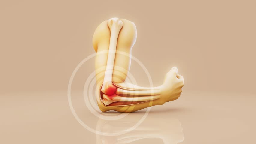 Conceptual 3D animation of a tennis elbow inflammation