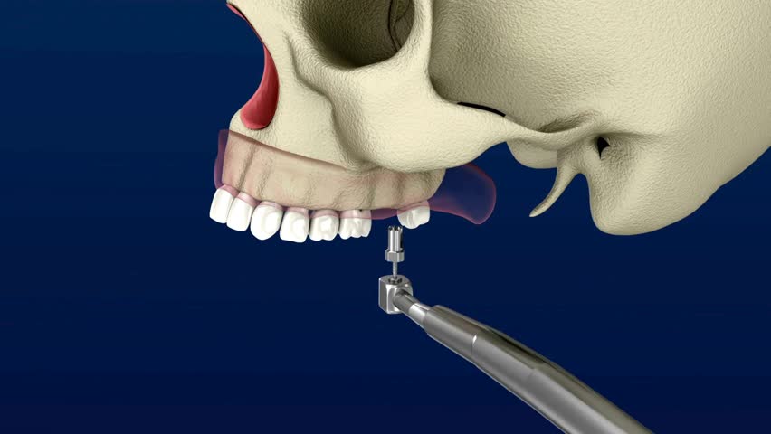 This video demonstrates sinus lift surgery, a dental procedure where the sinus floor is raised and bone graft material is added to prepare the upper jaw for secure dental implant placement.