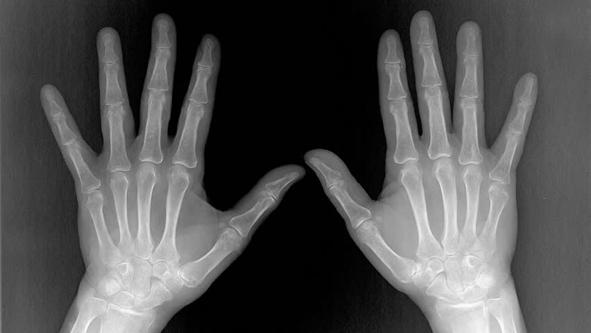 Medical X-ray of both hands highlighting finger joints in red and yellow to indicate arthritis or inflammation. Useful for medical, educational, and healthcare stock requires visuals