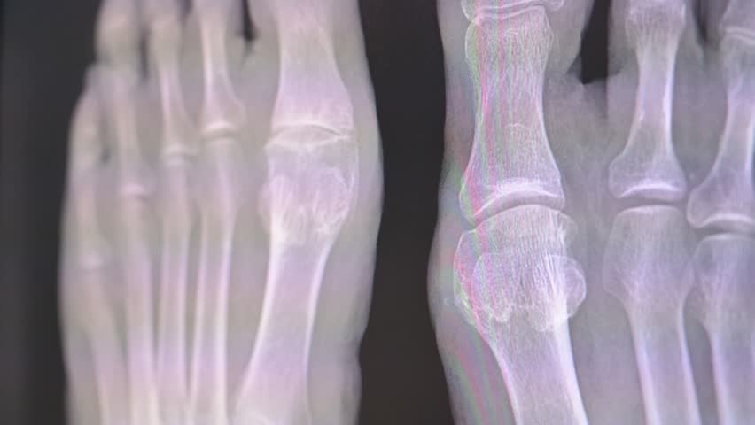 A clinician in blue gloves points to a foot X-ray, highlighting toe bones and a potential fracture. The scene conveys diagnostic analysis, orthopedic care, and clinical evaluation in a hospital
