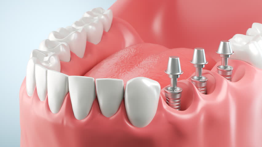 3D animation of Dental surgery, dental implants