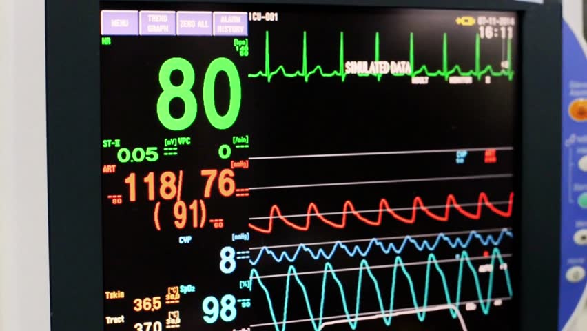 EKG monitor in ICU showing heartbeat and vital signs, symbolizing medical care, emergency monitoring, and modern healthcare technology.