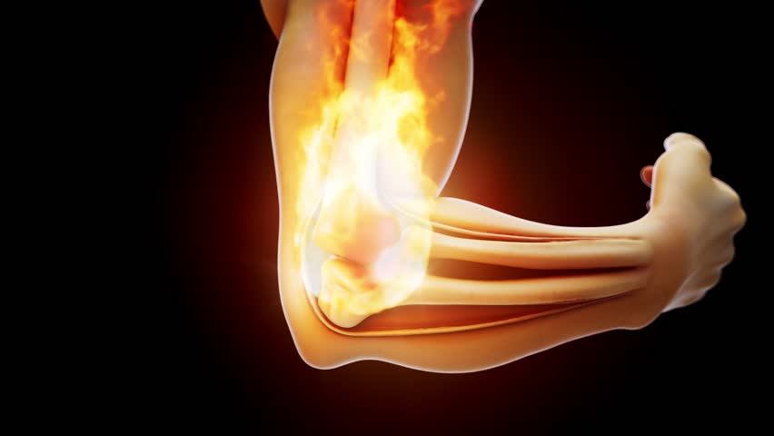 Conceptual 3D animation of a tennis elbow on fire