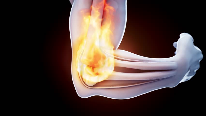 Conceptual 3D animation of a tennis elbow on fire