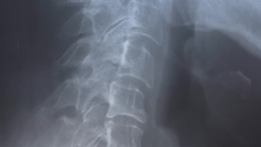 Side X-ray scan with displacement of intervertebral discs and herniation in the cervical spine.