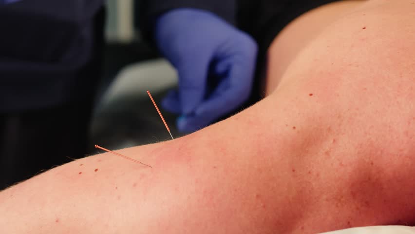 Chinese acupuncture needles, Adult male physiotherapist is doing acupuncture on the body back of a male patient. Patient is lying down on a bed, chinese sport medicine.