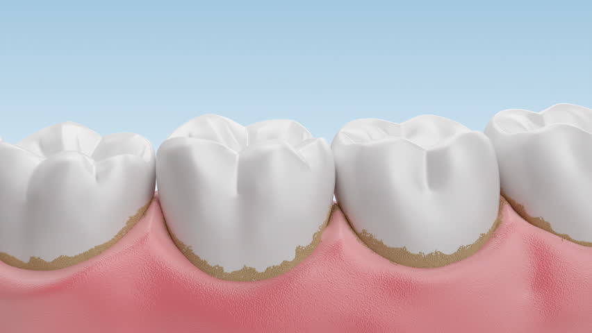 Dental plaque and Tartar,Teeth Cleaning dental care concept.
