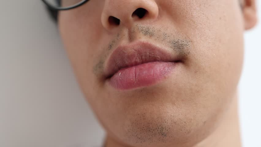 A man after five beard removal sessions. The patchy beard remaining around his mouth and chin.