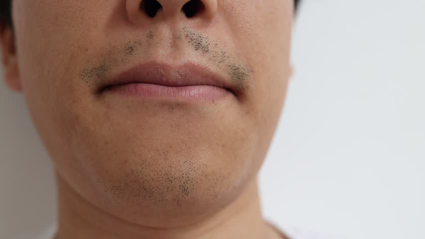 A man after five beard removal sessions. The patchy beard remaining around his mouth and chin.