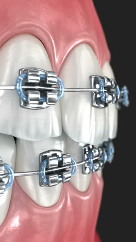 Metal braces on teeth. 3D animation