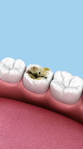 Dental onlay ceramic crown restoration. Animation of human teeth treatment