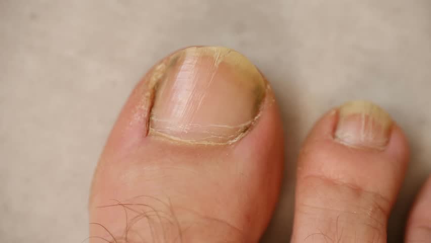 Closeup person foot with unhealthy, yellowed, and damaged toenails, common symptom of onychomycosis, nail fungal infection requiring podiatry treatment, care. Person toes showing nail fungus infection