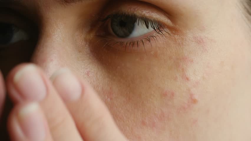 Close up young woman face applying moisturizing or healing cream to her problematic skin with acne, red spots, and dilated capillaries for healthy skincare routine. Woman applying cream on acne skin