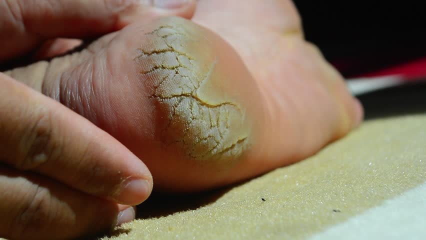 Close-up of badly cracked heel. Persons feet with dry skin. Barefoot man with unattractive and unhealthy foot. Salon treatment and skin procedure needed concept. Cracked dry skin,  Foot treatment.
