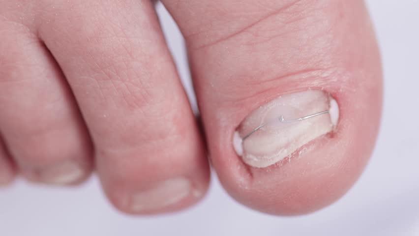 Close-up of big toe with fungal infection and nail damage after sealing with gel polish titanium bracket.