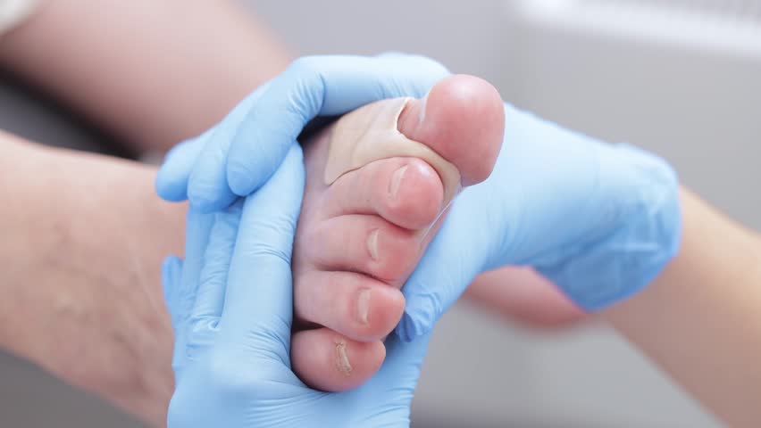 Podiatrist treating foot with toe separator in medical clinic.