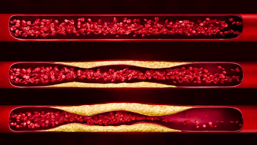 Artery clogged by unhealthy junk food, sugary drinks, and alcohol, illustrating serious cardiovascular risks, atherosclerosis, and heart disease problems in human blood vessels. 3D rendering.