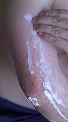 Man with red irritated skin applies medicated cream to relieve itching and inflammation showing skincare for problem skin.