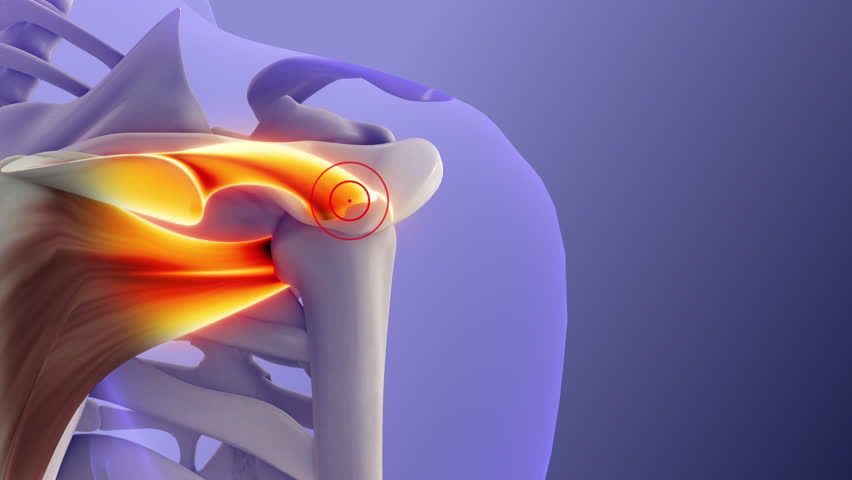 Anatomical View of Painful Rotator Cuff Muscles