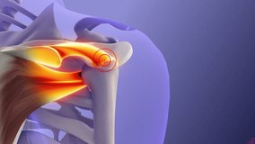 Anatomical View of Painful Rotator Cuff Muscles - Powered by Shutterstock - Get 15% off with code: PIKWIZARD15