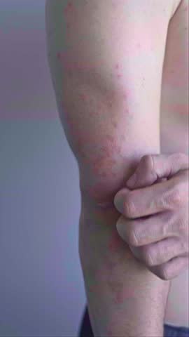 Man with skin irritation and inflammation after chemical exposure redness itching and peeling signs of contact dermatitis
