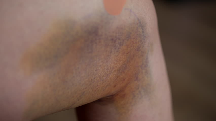 Woman touching large, discolored bruise on leg, showing large bruise and swelling after liposuction procedure, female touching painful leg with hand, recovering from plastic surgery consequences