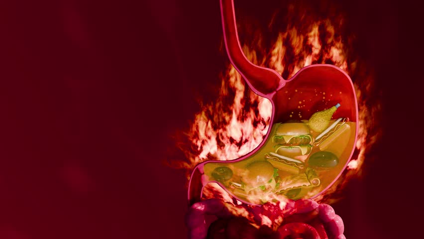 Digestive Problem and Indigestion Caused by Unhealthy Food, Stress, and Acidic Imbalance in Stomach Anatomy Model
