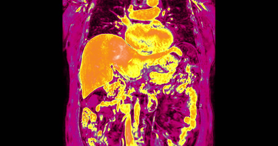 Colorful MRI upper abdomen showing vivid visualization of abdominal organs and vessels. Demonstrates advanced radiology imaging technology for precise medical diagnosis and research.