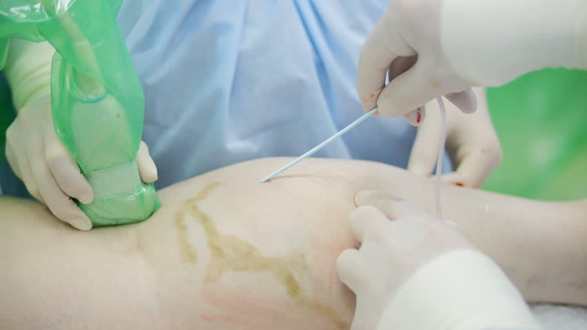 Endovenous laser ablation procedure on patient leg