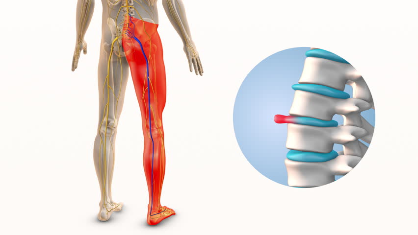 Back Pain and Sciatica Due to Bulging Disc