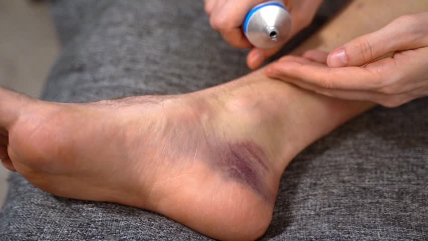 Hand applies clear soothing gel from tube to bruise on inner foot with purple wound. Concept of cooling aloe vera gel for post-contusion swelling, relief and natural plant-based aftercare therapy