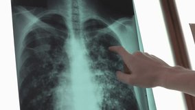 Rib cage X-ray with doctor pointing out issues in 4K, capturing medical examination, diagnostic imaging, and healthcare analysis. - Powered by Shutterstock - Get 15% off with code: PIKWIZARD15