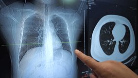 A doctor's hand points directly at a digital chest X-ray and CT scan displayed on a medical monitor. - Powered by Shutterstock - Get 15% off with code: PIKWIZARD15