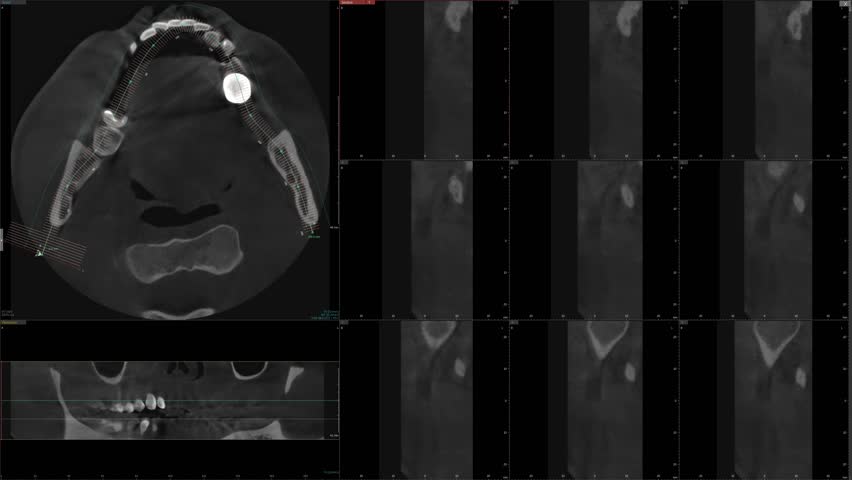 Animation of the screen of the software for MRI of teeth. Monitoring the health of the teeth using a skull scan. Dental examination. Examination at the dentist