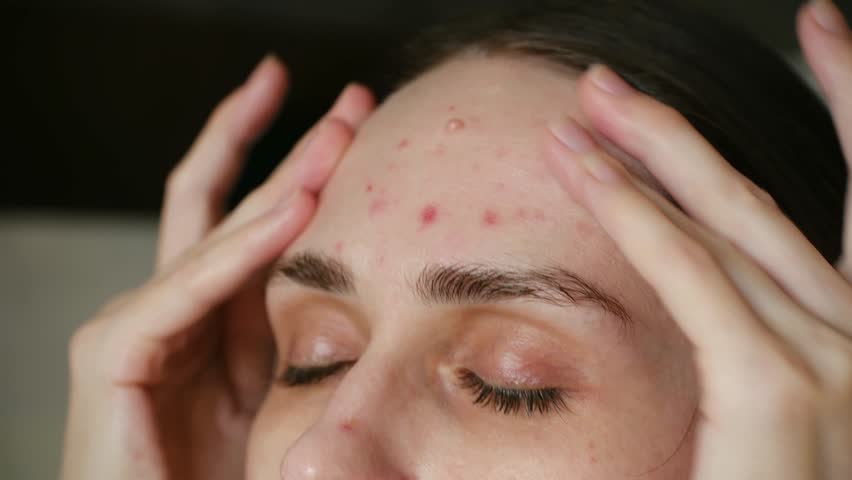closeup white woman forehead acne frustrated, fingers pressing temples, intense red pimples on forehead, macro focus on skin texture, tight crop, low light, expression of distress, product testing