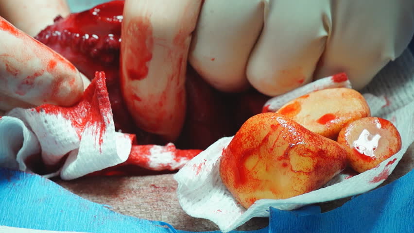 Veterinarian removing several large Bladder stones in a dog.
