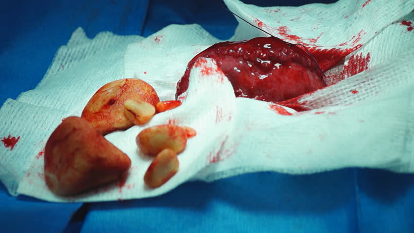 Veterinarian removing several large Bladder stones in a dog.