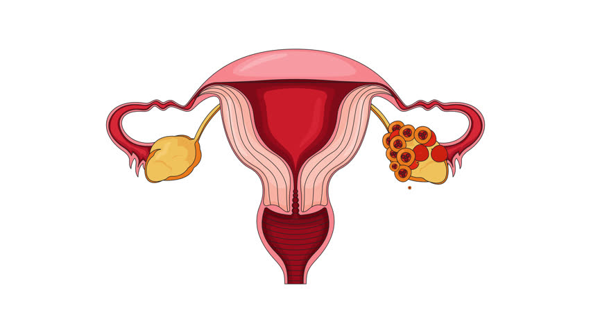 Late-stage ovarian cancer in female reproductive system cartoon animation. Oncology. Gynecological disease. Tumor clusters of ovary growing animated flat 2D object 4K video isolated on white
