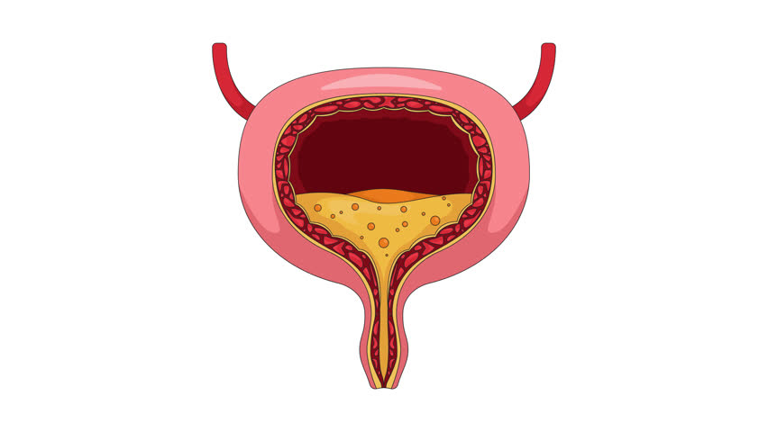 Overactive human bladder with urgency symptom cartoon animation. Urinary incontinence, spasms squeezing. Trembling walls and urine buildup animated flat 2D object 4K video isolated on white