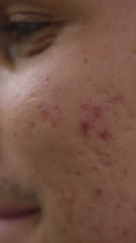 Young man applying acne controlling face wash for men to stop skin breakouts and acne scars, side view close up. Skin problem and disorder concepts.