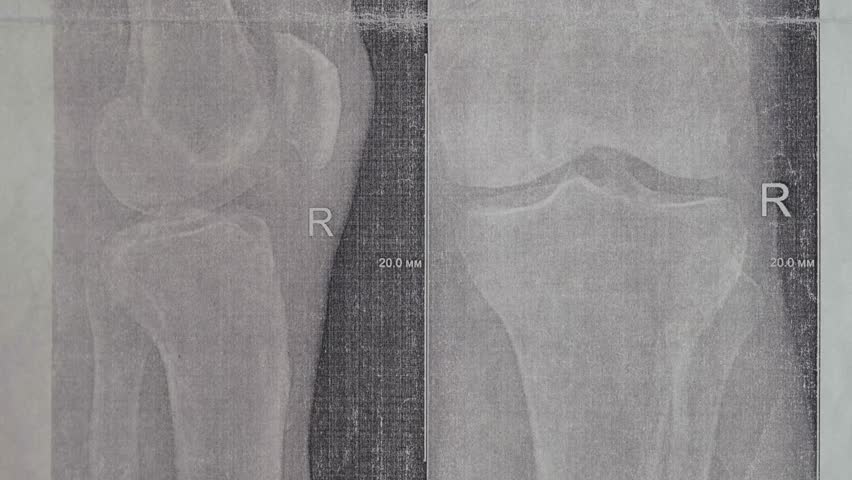 Doctor learn X-ray with narrowed joint space, compacted tibial endplate, exacerbation of intercondylar elevation of the tibia. Osteoarthritis of the knee joint.