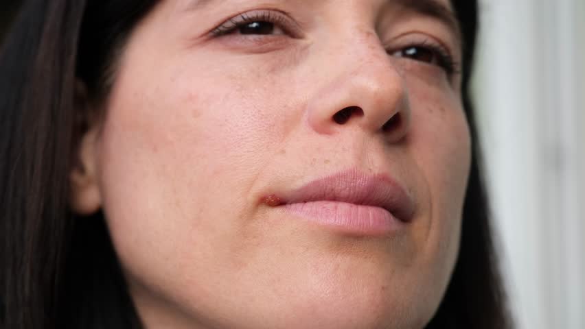 Close-up of a woman looking distressed as she gently touches a painful cold sore on her lip, showcasing the discomfort and skin inflammation caused by the herpes simplex virus infection