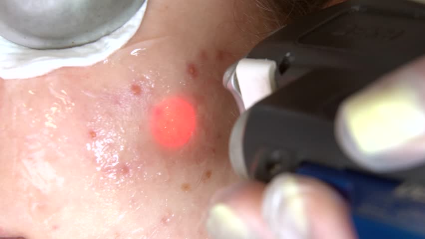 Close-up shot of Removal of blood vessels with a laser. Removal of red spots, rosacea, blood vessels, on the face of a Caucasian woman. 4k video. Laser removal of blood vessels in modern clinic.