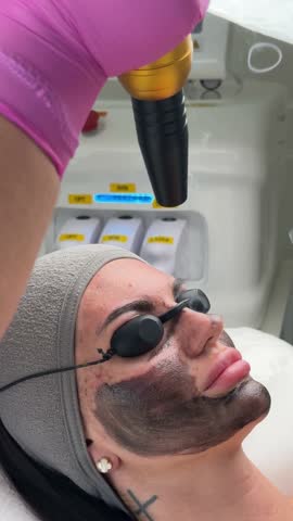 Young woman getting carbon laser facial at beauty clinic. Professional skincare treatment for deep pore cleansing, acne reduction and skin rejuvenation. Modern cosmetology procedure.